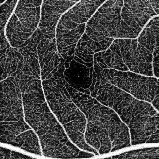 Diabetic Healthy Retina