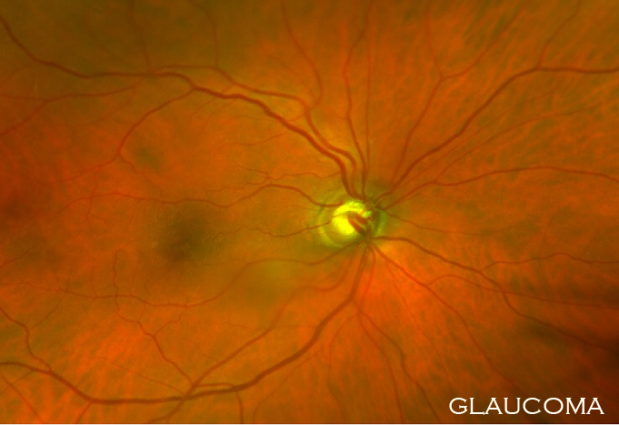 Glaucoma Nerve