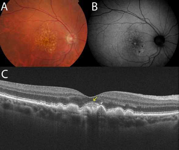 Macular Degeneration