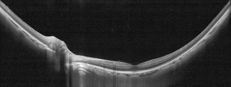 Healthy retina without macular degeneration 